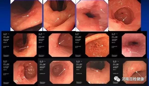 最新胃腸鏡技術(shù)，醫(yī)學(xué)領(lǐng)域的革新之星