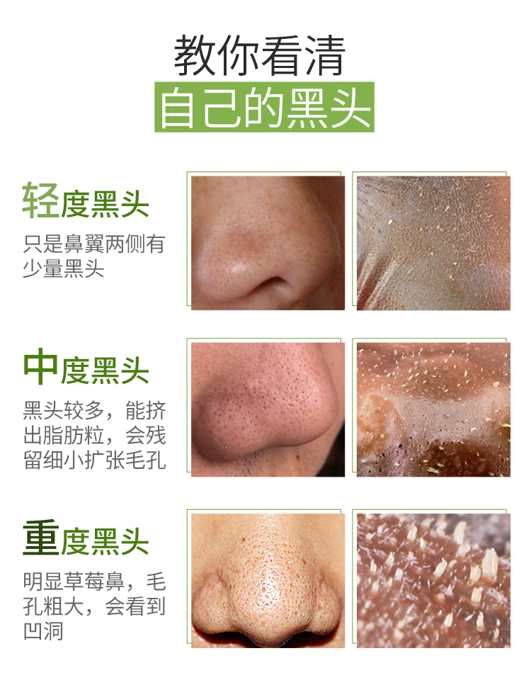 最新去黑頭教程視頻匯總，科技助力美麗重塑，黑頭無憂新篇章