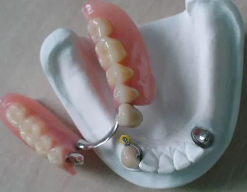 關(guān)于活動假牙價格的探討與解析