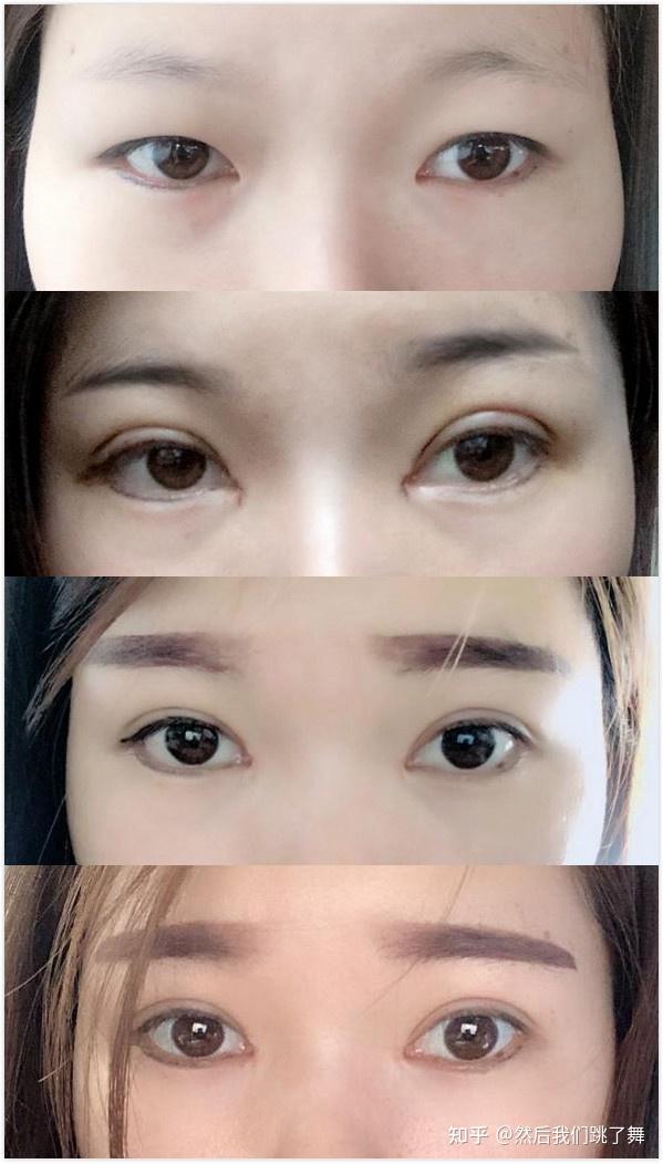 雙眼皮新技術(shù)揭秘，小明的魔法雙眼皮之旅