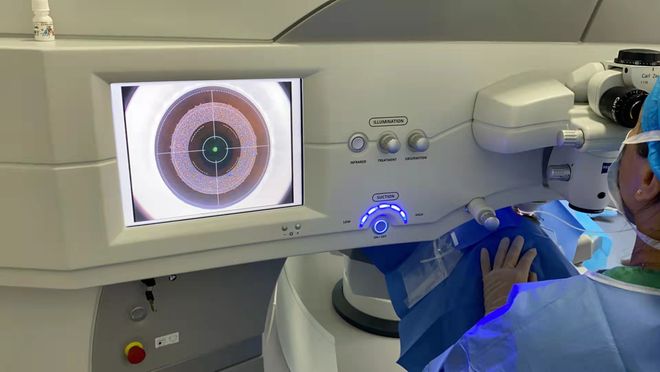 激光治療近視最新價格概覽